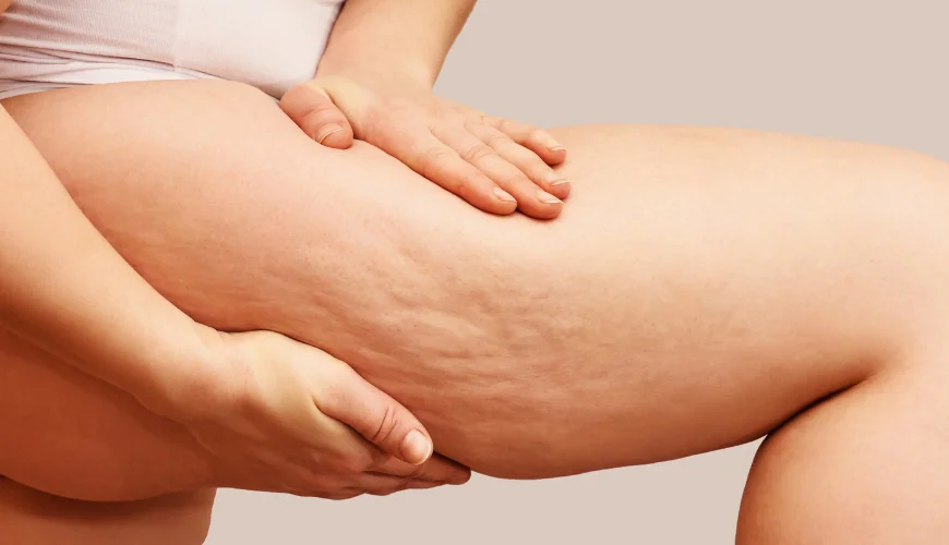 Moderne Behandlung bei Lipödem: Welche Methoden gibt es?